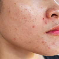 Các bước skincare cho da dầu mụn nhạy cảm đơn giản mà hiệu quả