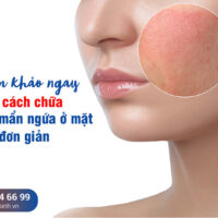 Tham khảo ngay 15 cách chữa dị ứng mẩn ngứa ở mặt đơn giản