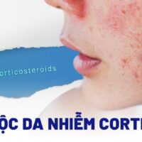 Cách thải độc da nhiễm Corticoid tại nhà hiệu quả bạn chưa biết