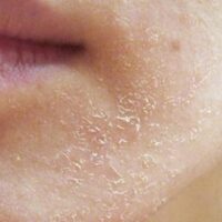 Da mặt sần sùi: Nguyên nhân và cách điều trị trong “một nốt nhạc” ngay tại nhà