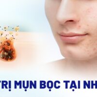 20+ cách trị mụn bọc tại nhà hiệu quả ít tiền ai cũng làm được