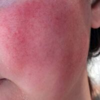 Da mặt bị rát không rõ nguyên nhân là bệnh gì? Có nguy hiểm không?
