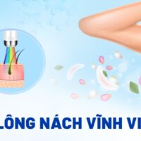 Triệt lông nách vĩnh viễn là gì? Có nên không? Ưu nhược điểm