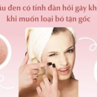 Có nên nặn mụn đầu đen? Cách thực hiện an toàn, đỡ hại da