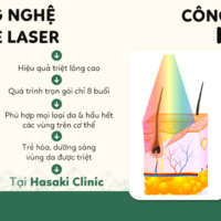 Ưu và nhược điểm của công nghệ triệt lông Diode Laser