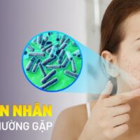 Top 7 nguyên nhân gây mụn phổ biến và những điều cần lưu ý