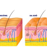 Tình trạng da khô có phải là triệu chứng thông thường như bạn vẫn nghĩ?