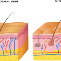 Nguyên nhân gây khô da và cách chăm sóc da khô hiệu quả, an toàn
