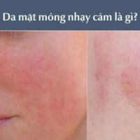 Cách chăm sóc da mặt mỏng nhạy cảm giúp da phục hồi hiệu quả