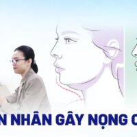 Nọng cằm (mặt nọng): Nguyên nhân, dấu hiệu, cách phòng ngừa