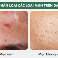 Có Nên Nặn Mụn Không? Nặn Mụn Tại Nhà Hay Tại Spa?