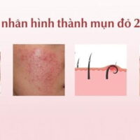 Cách trị mụn đỏ 2 bên má hiệu quả cấp tốc không thâm sẹo