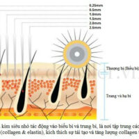 Hình ảnh trước và sau lăn kim