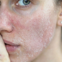 8 cách làm mặt nạ trị mụn cho da khô hiệu quả, nhanh hết mụn