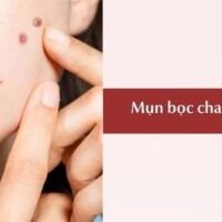 Mụn bọc chai cứng: Nguyên nhân, cách điều trị và có nên nặn?