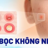 Mụn bọc không đầu (nhân): Nguyên nhân, triệu chứng, điều trị