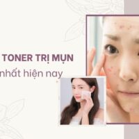 Điểm danh 9 toner trị mụn được yêu thích nhất hiện nay