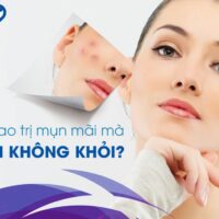 Vì sao nên điều trị mụn tại bệnh viện có chuyên khoa da liễu?