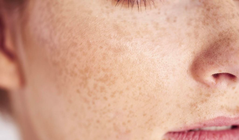 Chăm sóc da sau khi đốt tàn nhang​ như thế nào để nhanh chóng phục hồi?