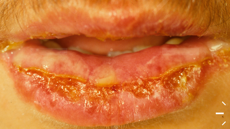 Viêm môi bong vảy sau phun môi: Nguyên nhân và cách điều trị