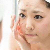 Hướng dẫn các bước skincare cho da mụn tuổi dậy thì đúng cách