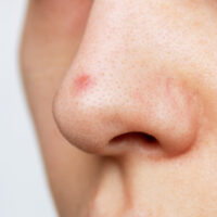 8 cách trị mụn bọc ở mũi hiệu quả không để lại vết thâm