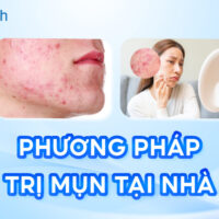 8 Cách trị mụn tại nhà do chuyên gia đề xuất