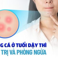 Mụn trứng cá ở tuổi dậy thì: Nguyên nhân, dấu hiệu, phòng ngừa