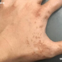 Xuất hiện vết thâm đen trên da tay: Cảnh báo nguy hiểm cần chú ý