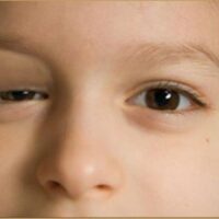 Sụp mi mắt: nguyên nhân cơ chế và cách điều trị