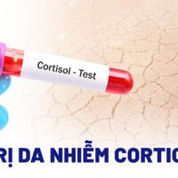 9 cách điều trị da nhiễm Corticoid tại nhà phục hồi tốt