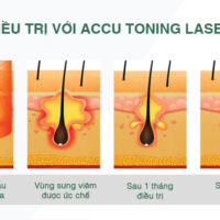 Trị Mụn - Kiểm Soát Dầu Accu Toning Laser