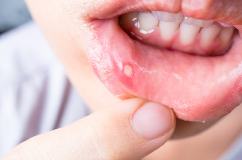 Nổi mụn trắng trong miệng không đau là dấu hiệu bệnh gì?