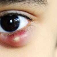 Mí mắt nổi mụn nước có nguy hiểm hay không? Hướng xử lý tốt nhất